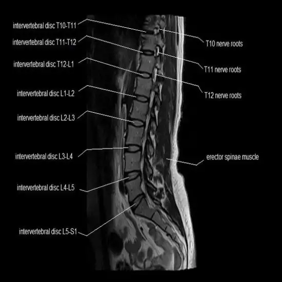 MRI Dorsal Lumbar Spine